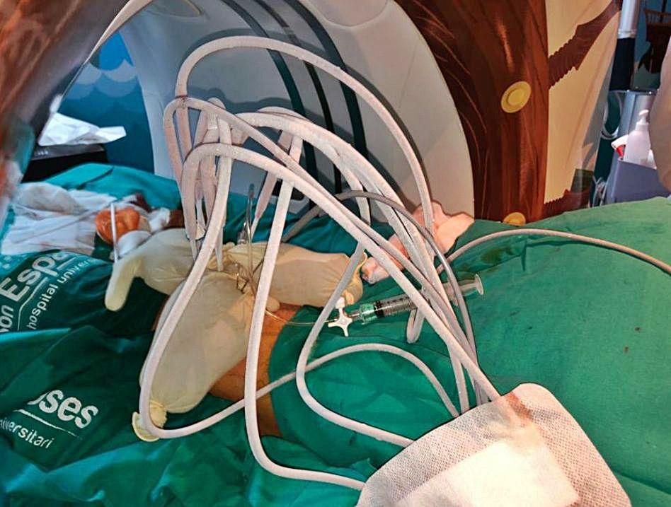 Al paciente se le introdujeron hasta 8 sondas para congelar el tumor.