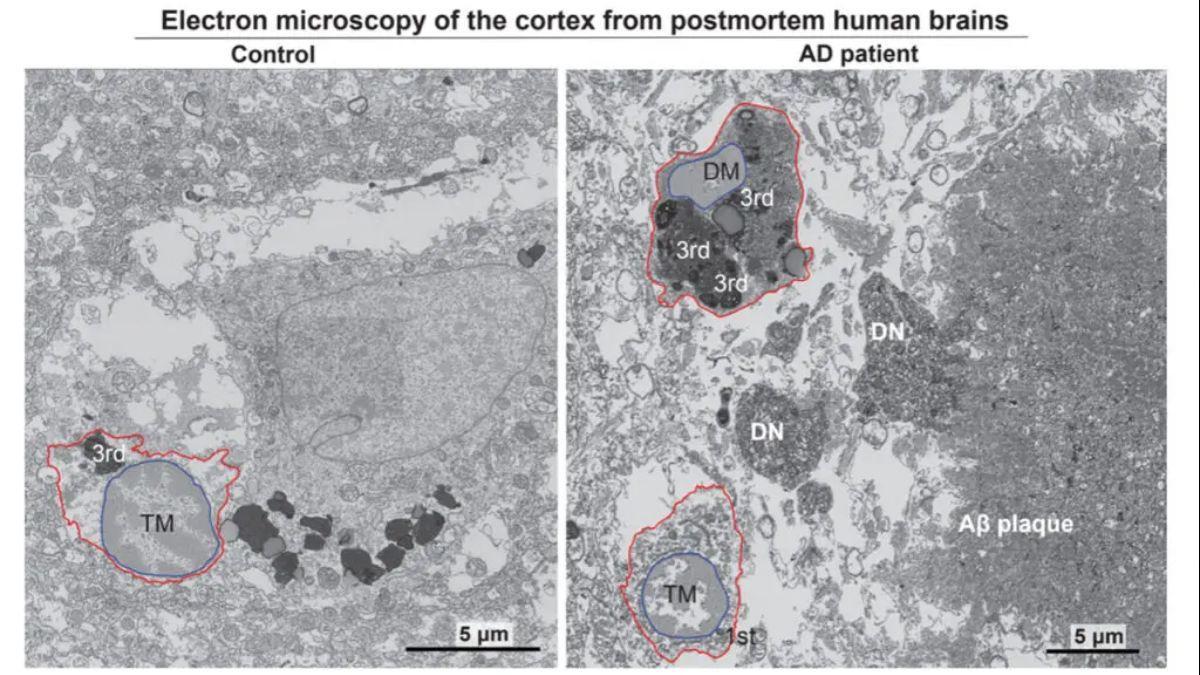 Las micrografías electrónicas muestran una microglia típica en la corteza prefrontal de una mujer sana de 92 años (izquierda) y una microglia “oscura”, en una paciente femenina de 91 años con enfermedad de Alzheimer (derecha).