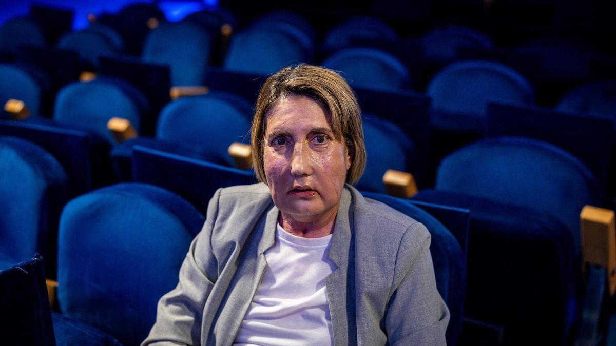 Vall d'Hebron realiza el primer trasplante de cara del mundo con una donante fallecida por eutanasia: "Ya puedo tragar y hablar"