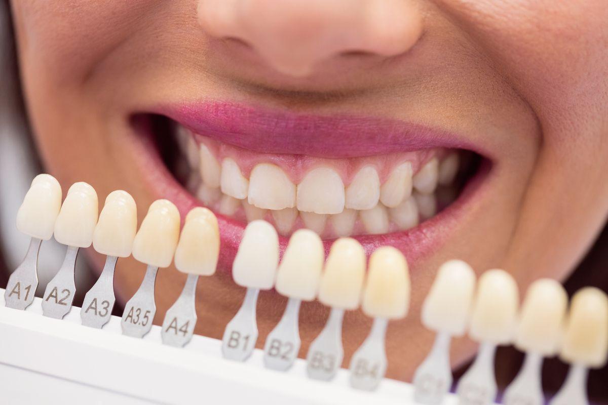 Los pacientes con carillas dentales son los que más peligros tienen de morderse las uñas