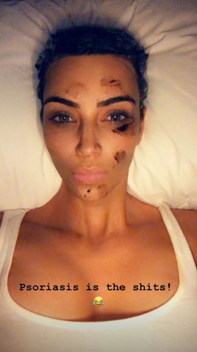 Así combate Kim Kardashian la psoriasis