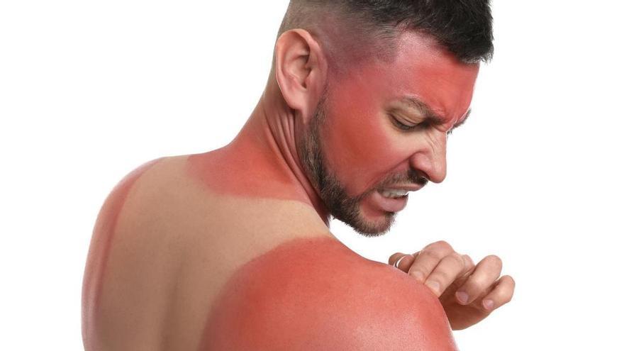 Cinco remedios caseros para aliviar las quemaduras del sol