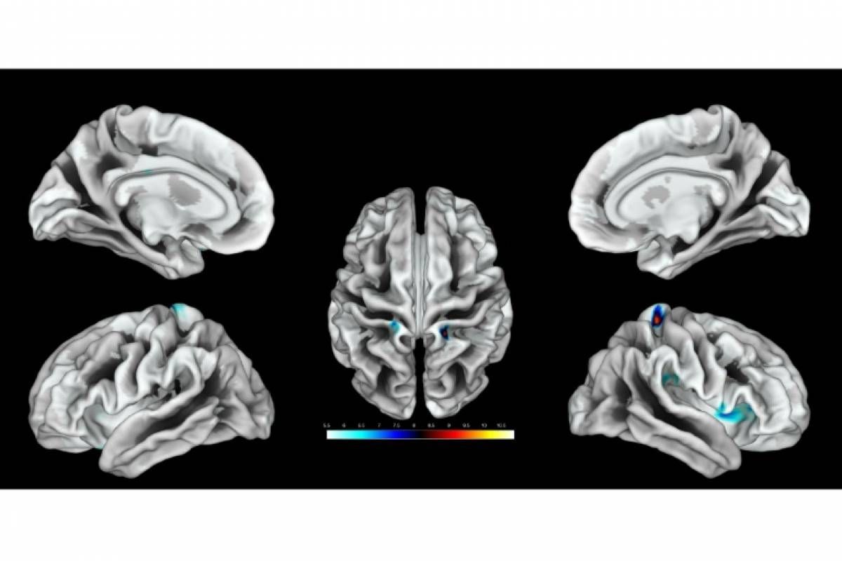 Ubicación de la región del cerebro activada por estimulación del clítoris en un grupo de mujeres.