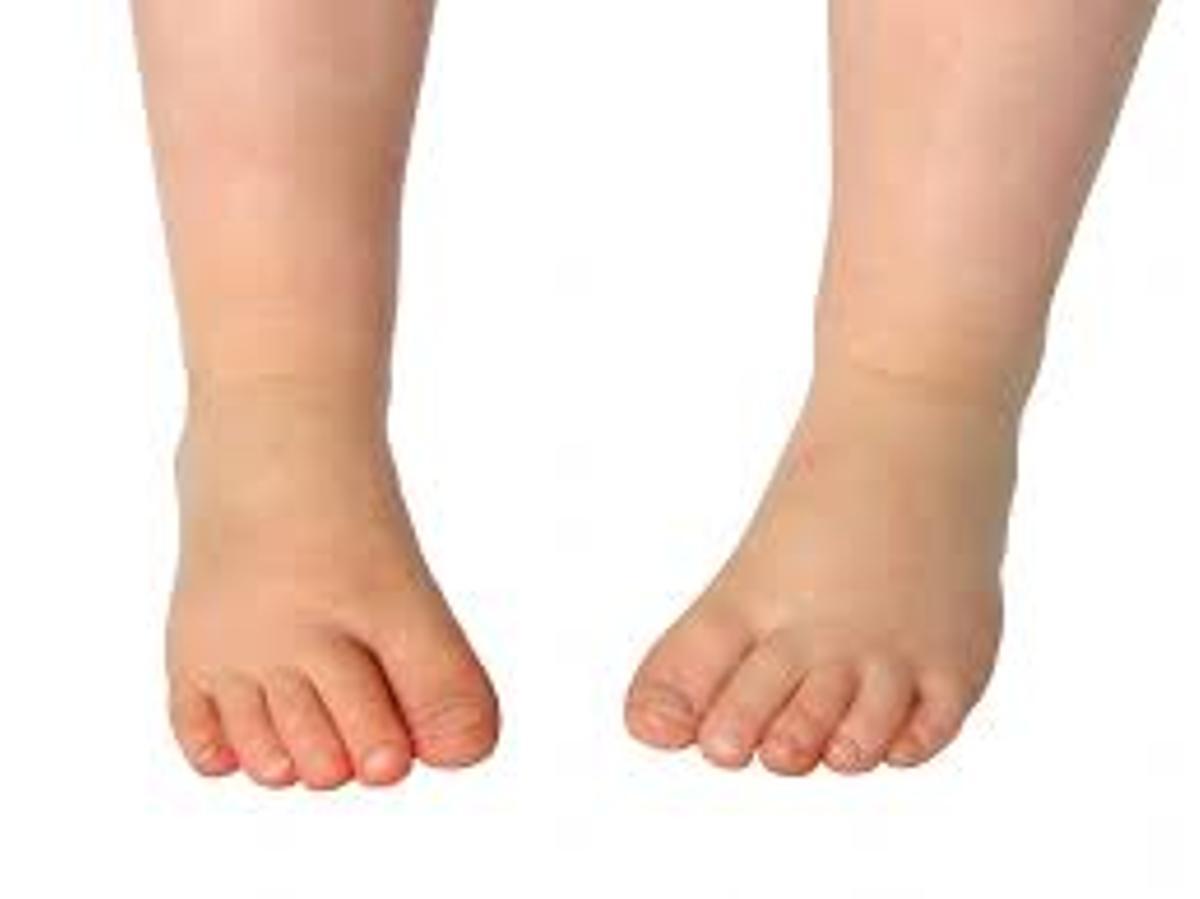 Piernas de una niña con marcha en aducción o marcha con la punta de los pes hacia dentro