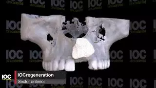 Simulación de regeneración ósea en la parte anterior
