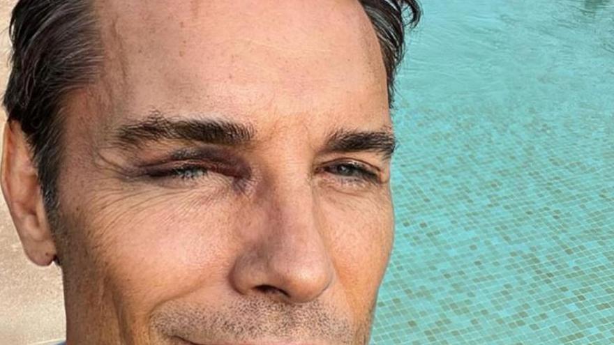 Jesús Vázquez sufre un accidente en Ibiza
