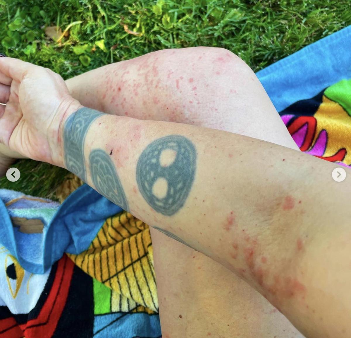 La alergía de Alaska a los perros le provoca esta reacción cutánea