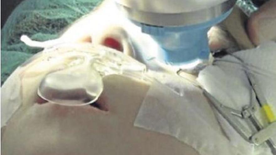 El Clínico implanta una nueva técnica para tratar las cataratas en niños