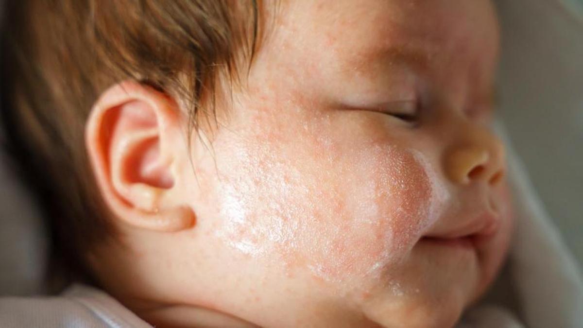 Dermatitis atòpica en nadons