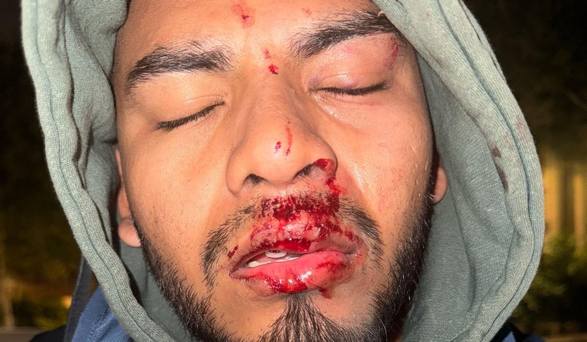 El joven de 24 años presenta fractura del maxiliar superior y desplazamiento de piezas dentales.