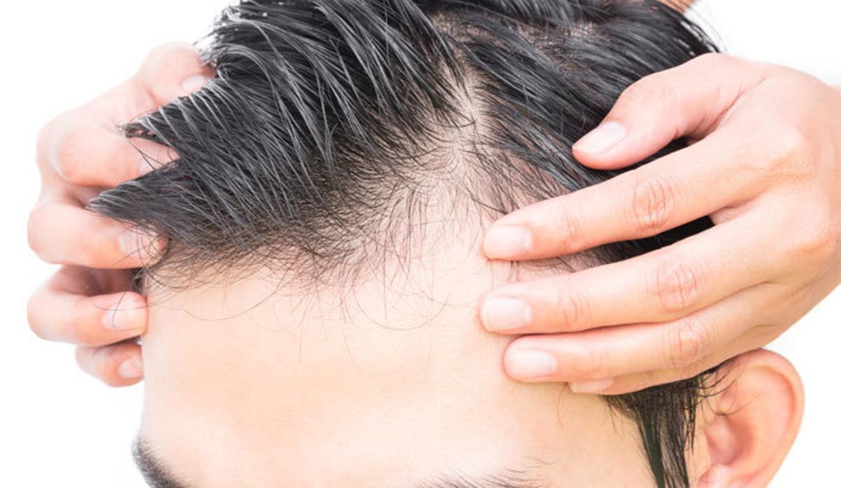 Caída del cabello: ¿Cuándo debes preocuparte?