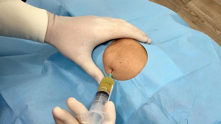 Una terapia celular eficaz y sencilla para la artrosis de rodilla