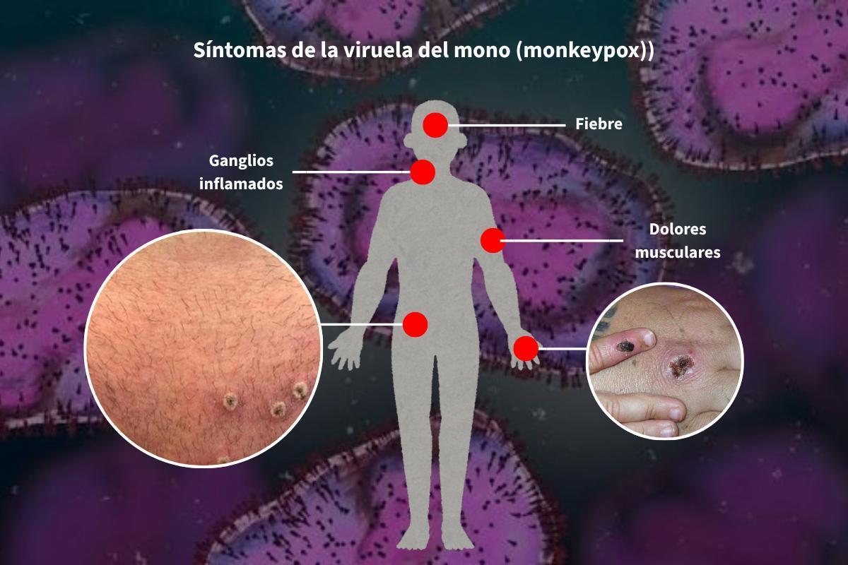 Síntomas de la viruela del mono