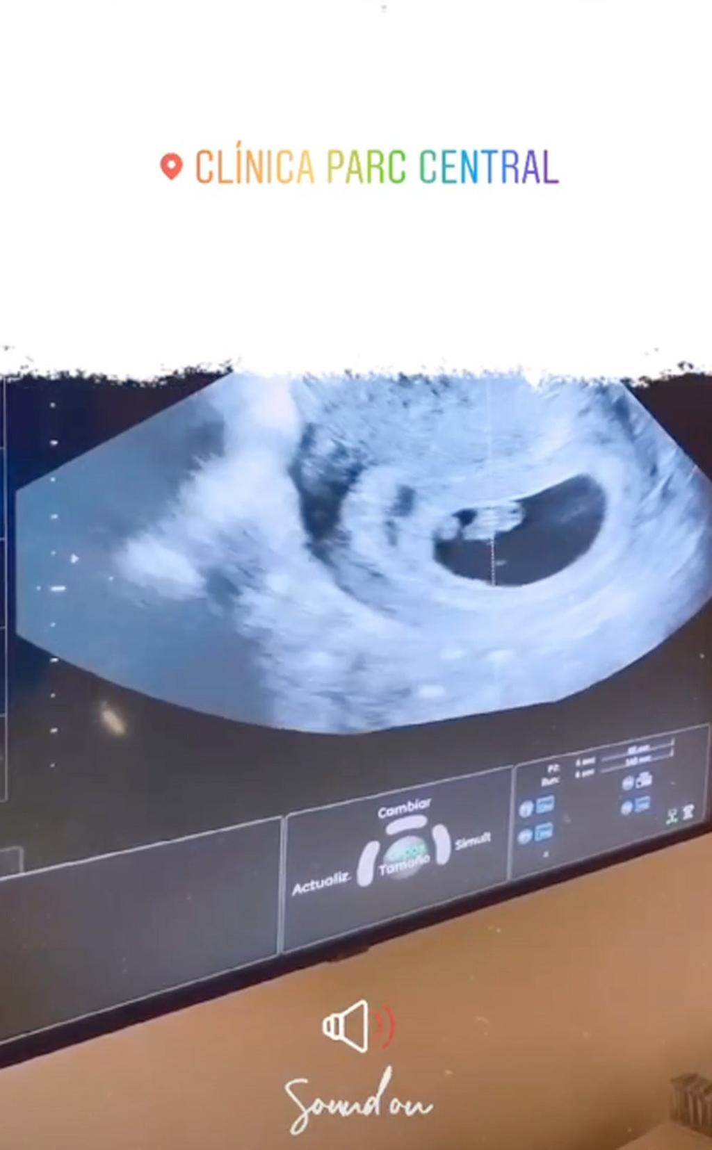 Ecografía de Yoli ('GH')