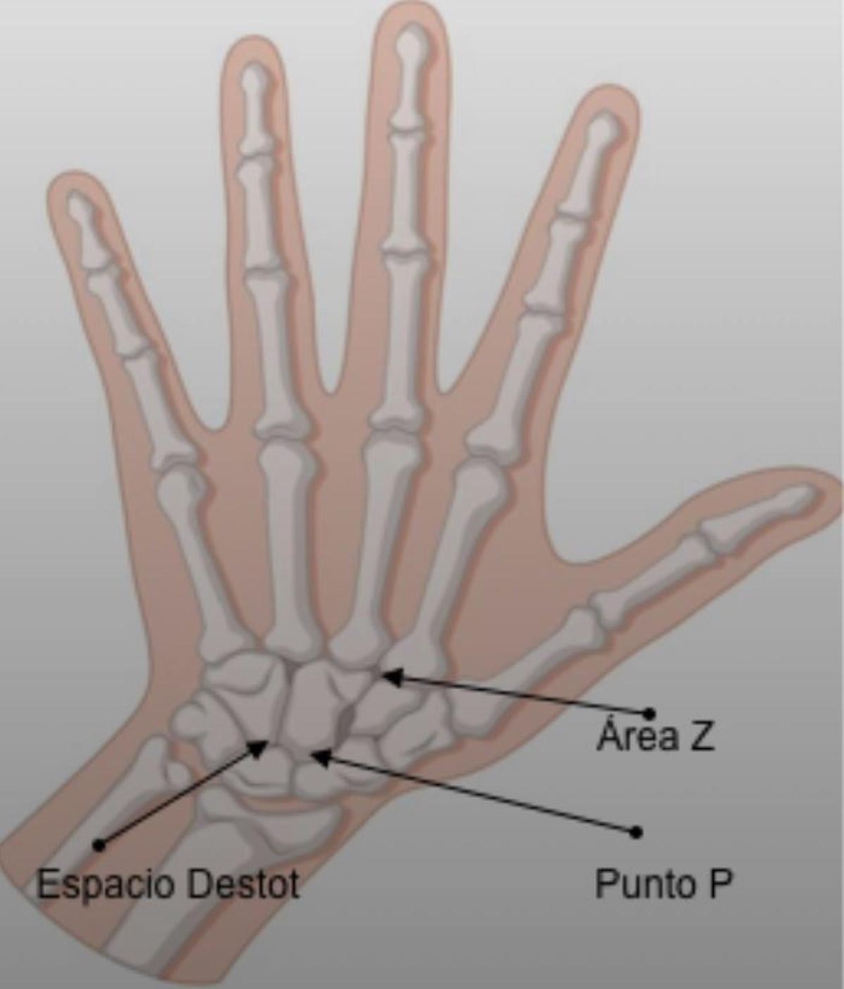 Esquema óseo del carpo que muestra las tres regiones anatómicas teóricas de ubicación del clavo. Espacio de Destot, área Z propuesta por el profesor Frederick Zugibe y el punto P del Dr. Lagraña.
