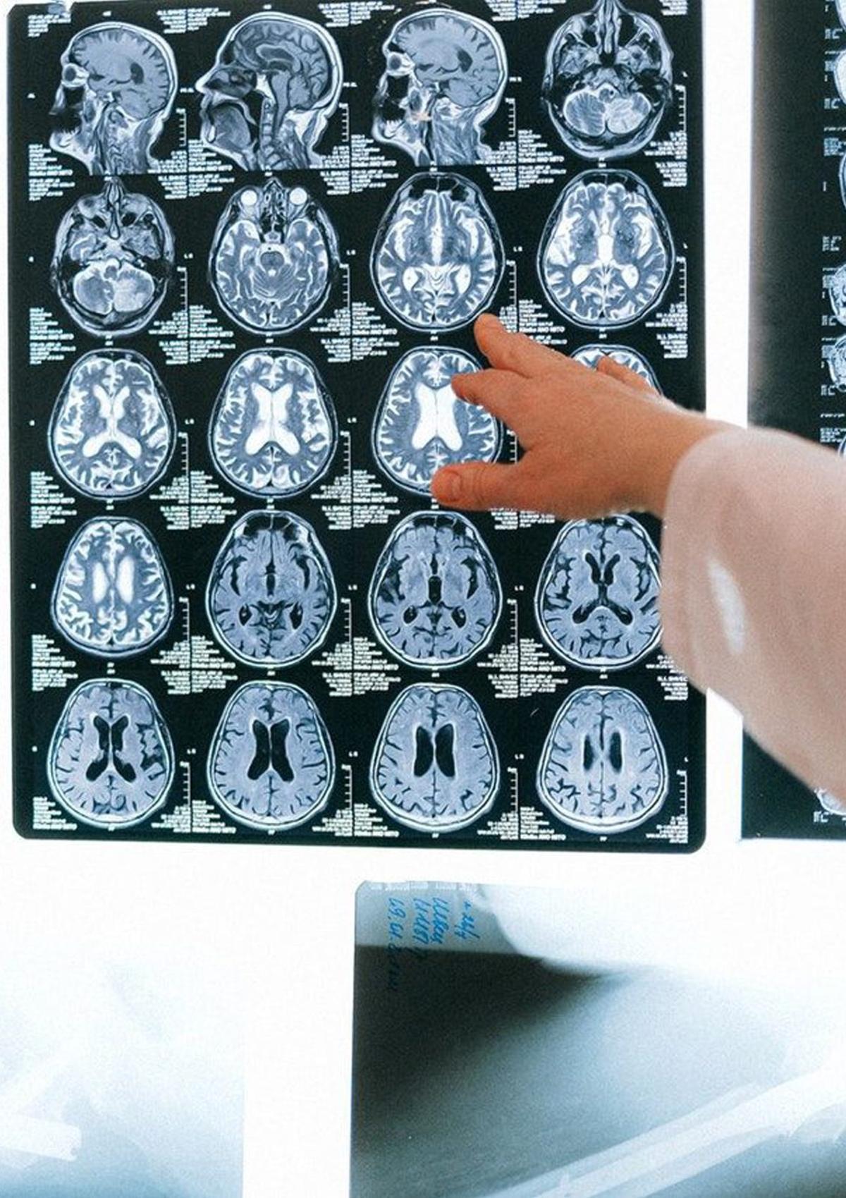Can Ruti i Sant Pau assajaran una cirurgia de l’Alzheimer