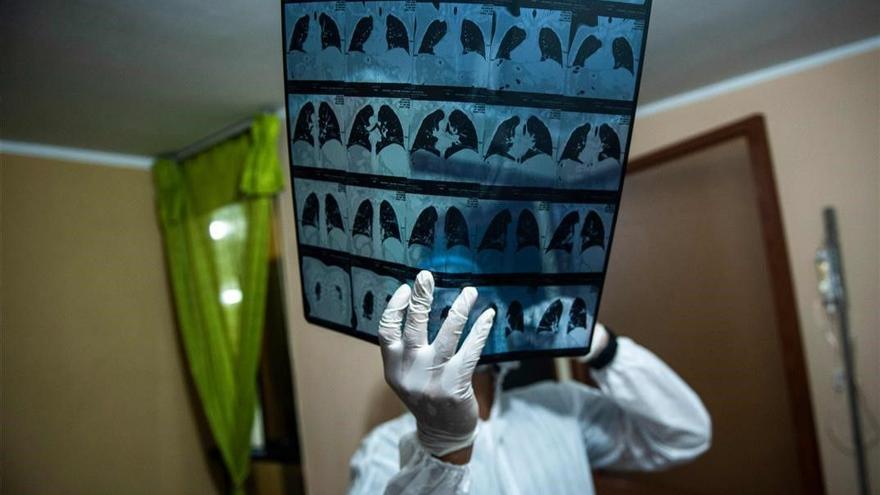 Radiografies d&#039;un pacient amb coronavirus