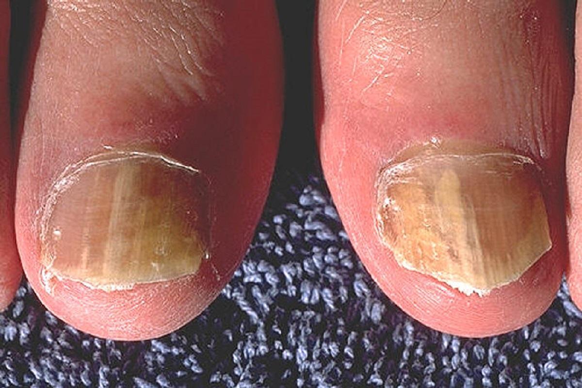 Son habituales las alteraciones en el color y la superficie de las uñas de los pies.