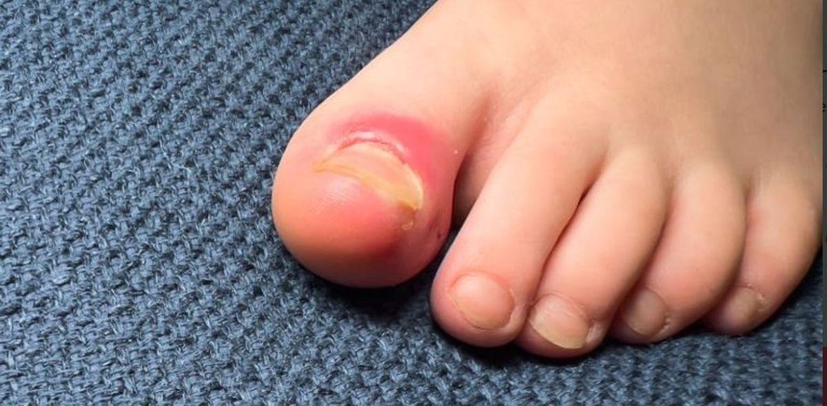 La una encarnada provoca inflamación y dolor a quienes padecen esta afección.