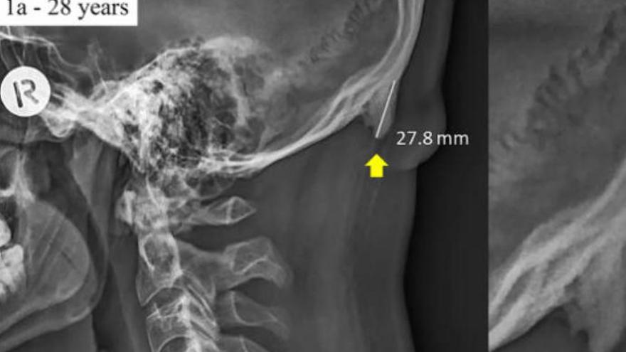 Radiografía de un individuo con un cuerno de 2,7 centímetros en la parte de atrás del cráneo.