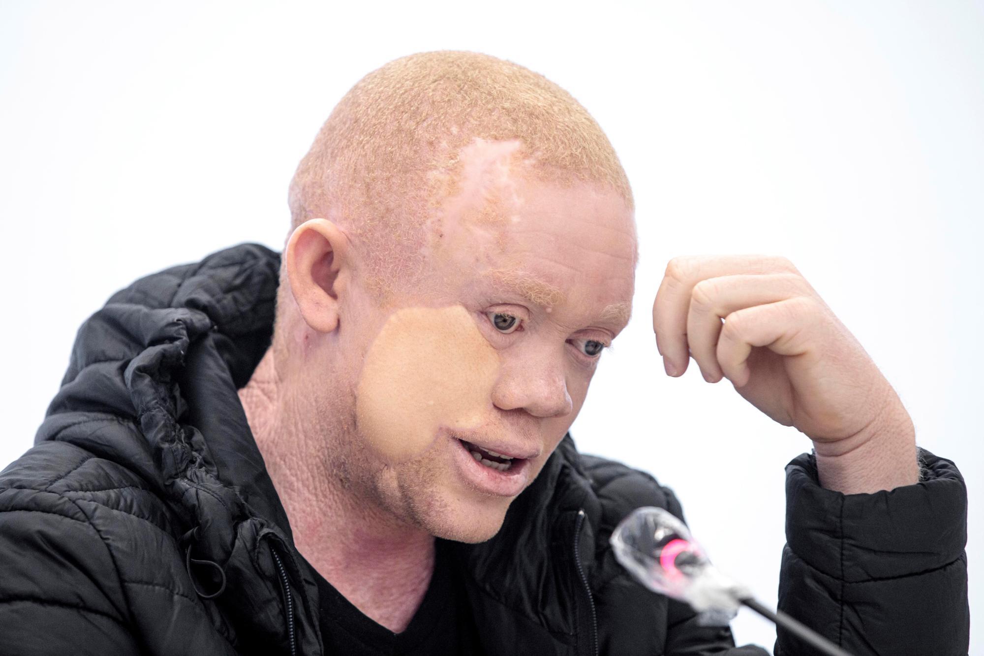 Cavadas reconstruye la cara a un paciente albino