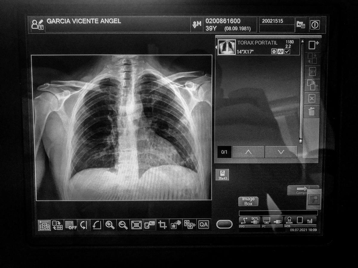 Resultado al momento de la radiografía realizada de mis pulmones, para ver cómo evolucionaba el inicio de neumonía que se me diagnosticó.