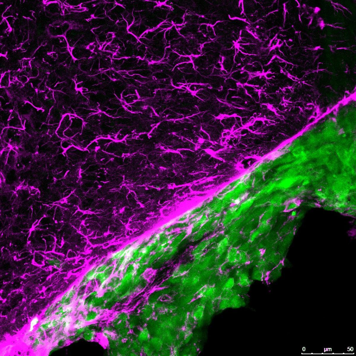 Imagen de una metástasis (color verde) creciendo en el cerebro