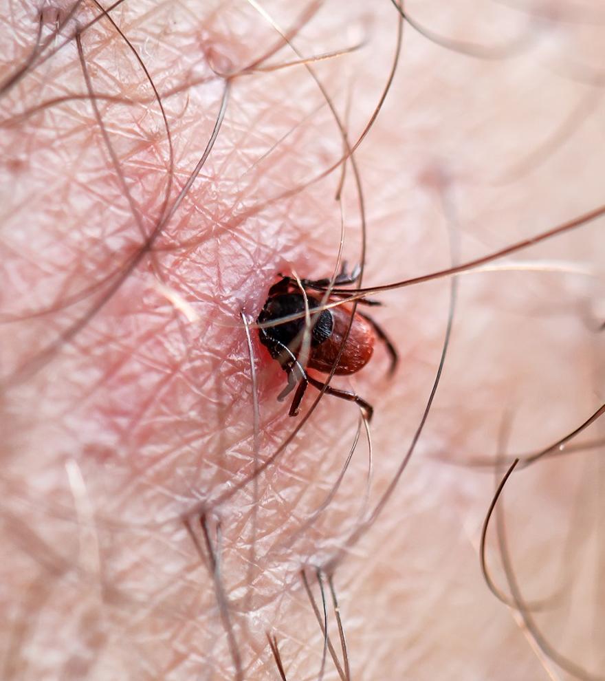 Picaduras de garrapatas: cómo prevenir la enfermedad de Lyme, que puede causar discapacidad