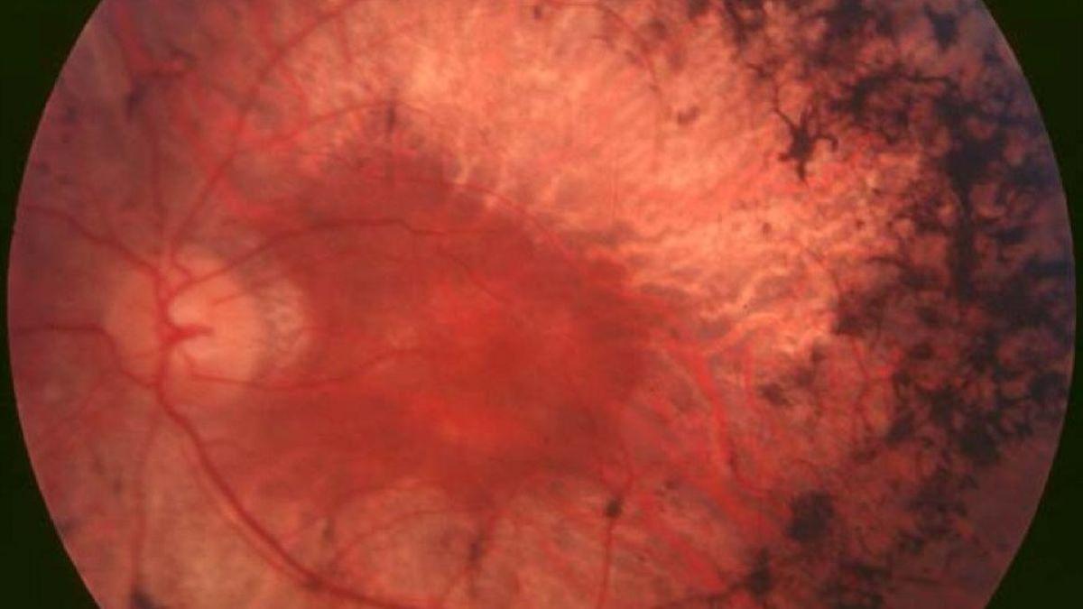 Un implante de retina inalámbrico logra restaurar señales visuales y abre una nueva vía contra la ceguera Un implante de retina inalámbrico logra restaurar señales visuales y abre una nueva vía contra la ceguera