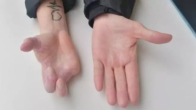 La mujer que perdió su mano en un aserradero de Zamora: "No puedo pedir mis dedos, pero sí justicia"