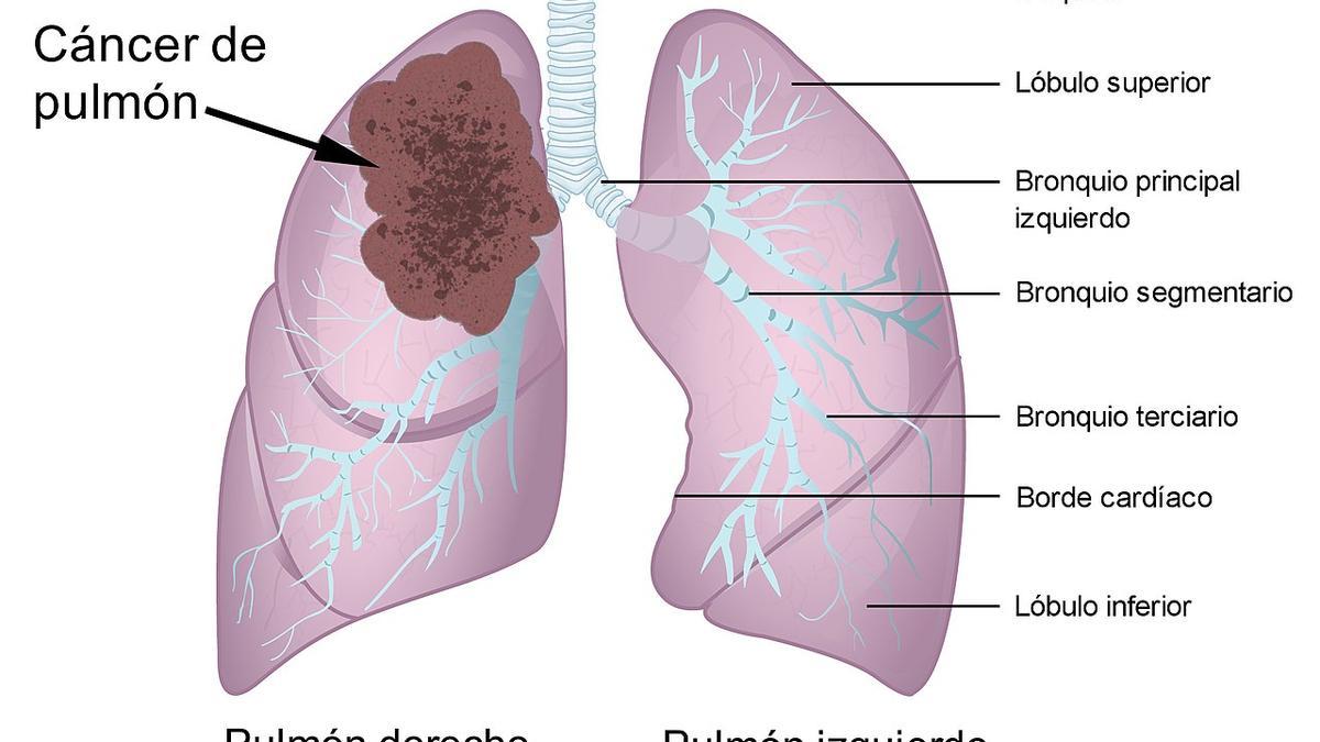 Esquema en el que se muestran las estructuras principales del sistema respiratorio y un cáncer de pulmón