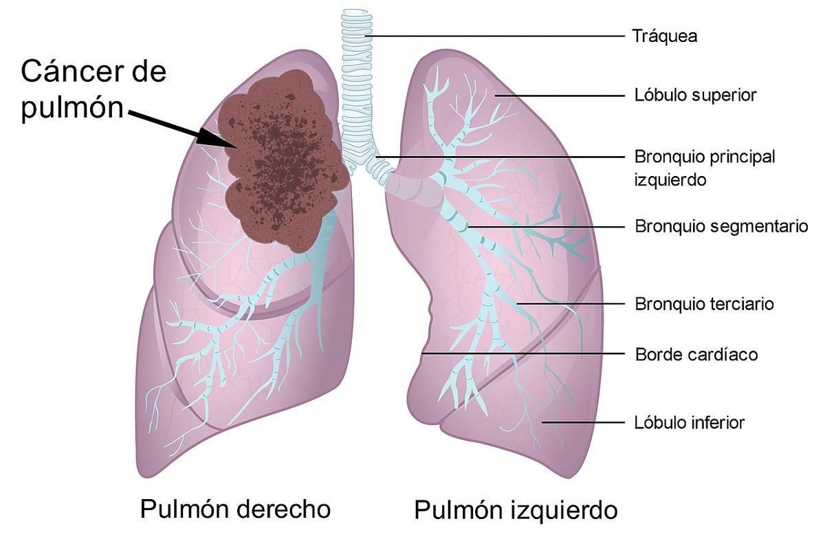 Esquema en el que se muestran las estructuras principales del sistema respiratorio y un cáncer de pulmón