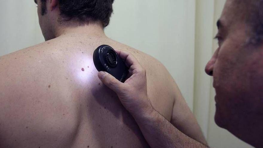 El Servet diagnostica 70 casos nuevos de melanoma al año