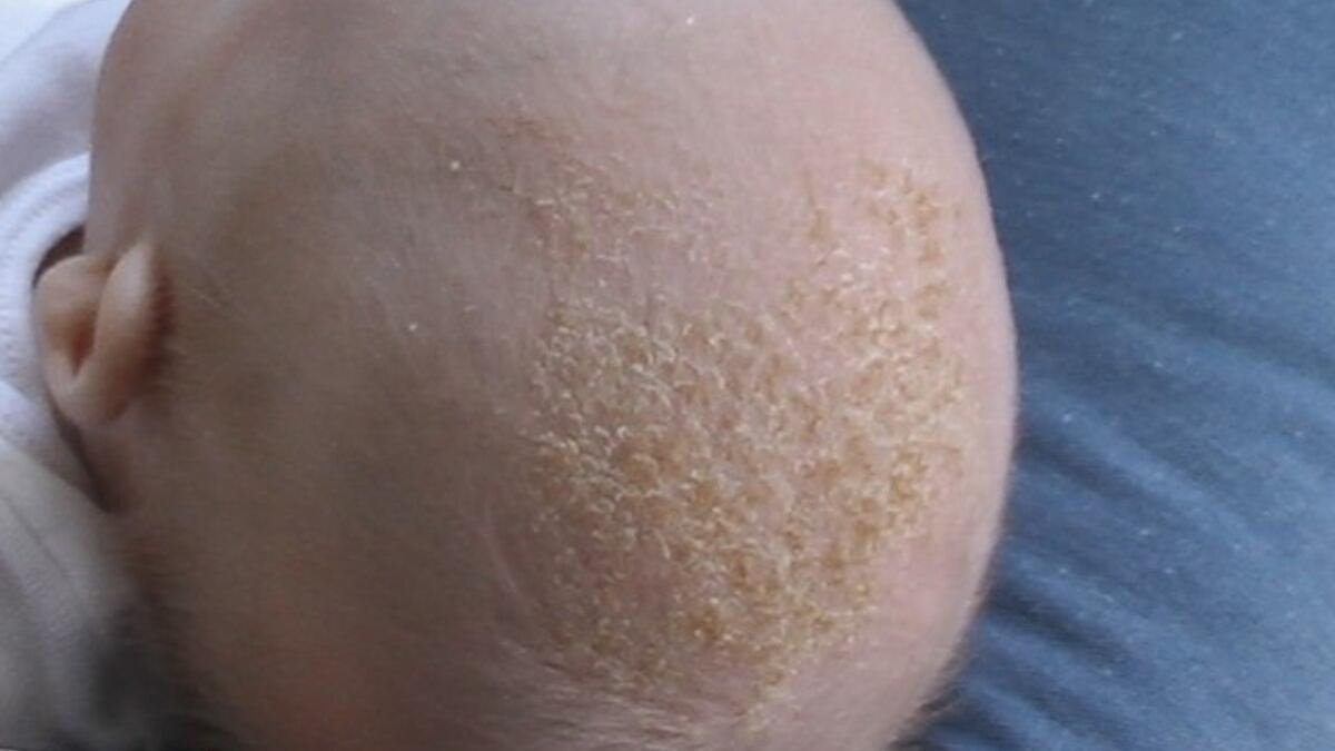 La dermatitis seborreica se perenta con una costra de color rojo o amarillo