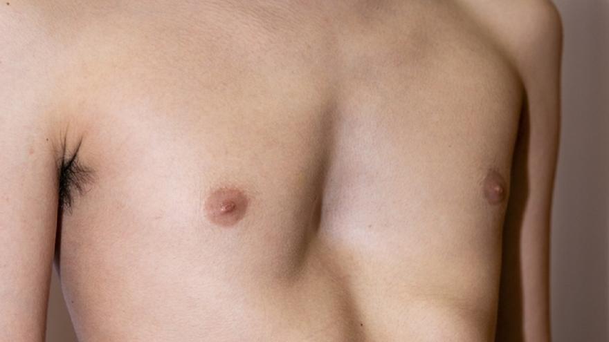 What is a chiseled chest?  Is it serious, how does it affect, and how can it be treated?