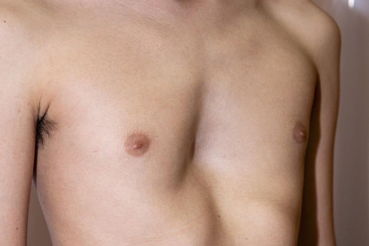 ¿Qué es el tórax excavado? ¿Es grave?