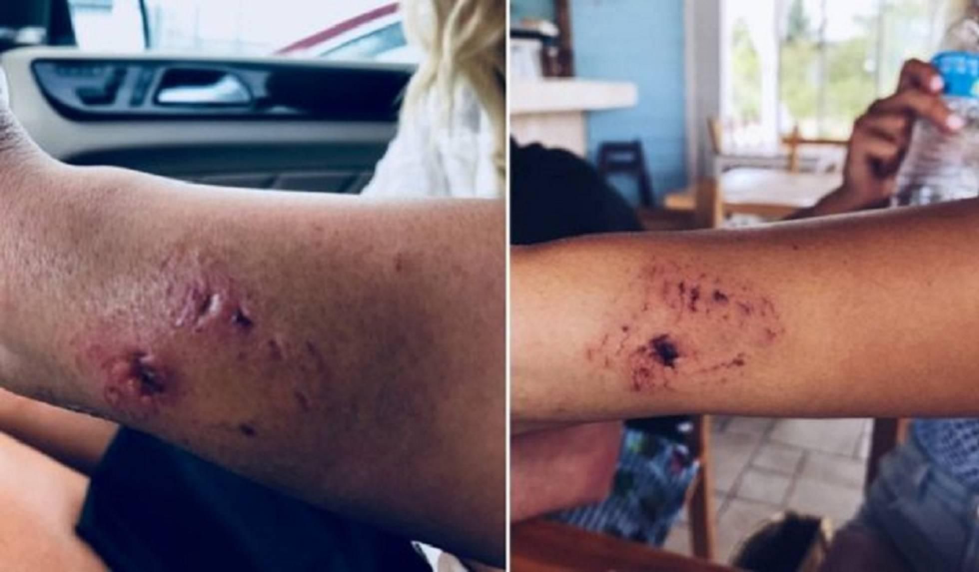 Heridas provocadas por el ataque del tiburón