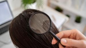 La caspa es uno de los síntomas que presenta la dermatitis seborreica en el cuero cabelludo.