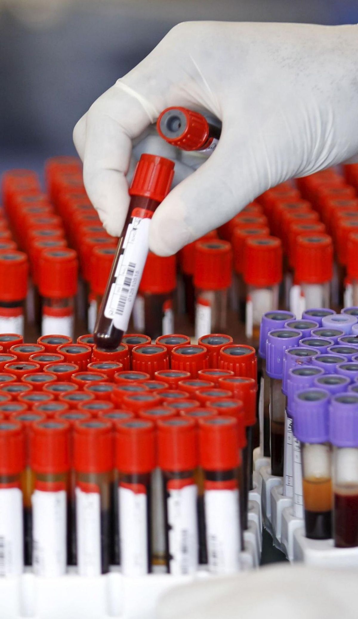 La biòpsia líquida ajuda al diagnòstic del càncer colorectal La biòpsia líquida ajuda al diagnòstic del càncer colorectal