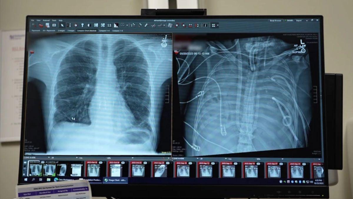 Las radiografías muestran los pulmones nuevos (izquierda) y los pulmones viejos (derecha) del paciente de 33 años que fue intervenido.