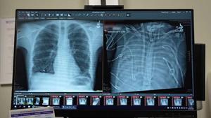 Las radiografías muestran los pulmones nuevos (izquierda) y los pulmones viejos (derecha) del paciente de 33 años que fue intervenido.