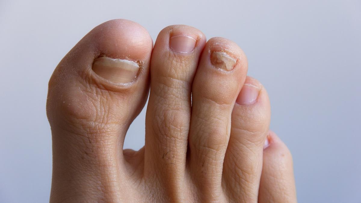 Cambios de color en las uñas o la aparición de rugosidades en ellas son algunas de las señales de problemas en los pies.