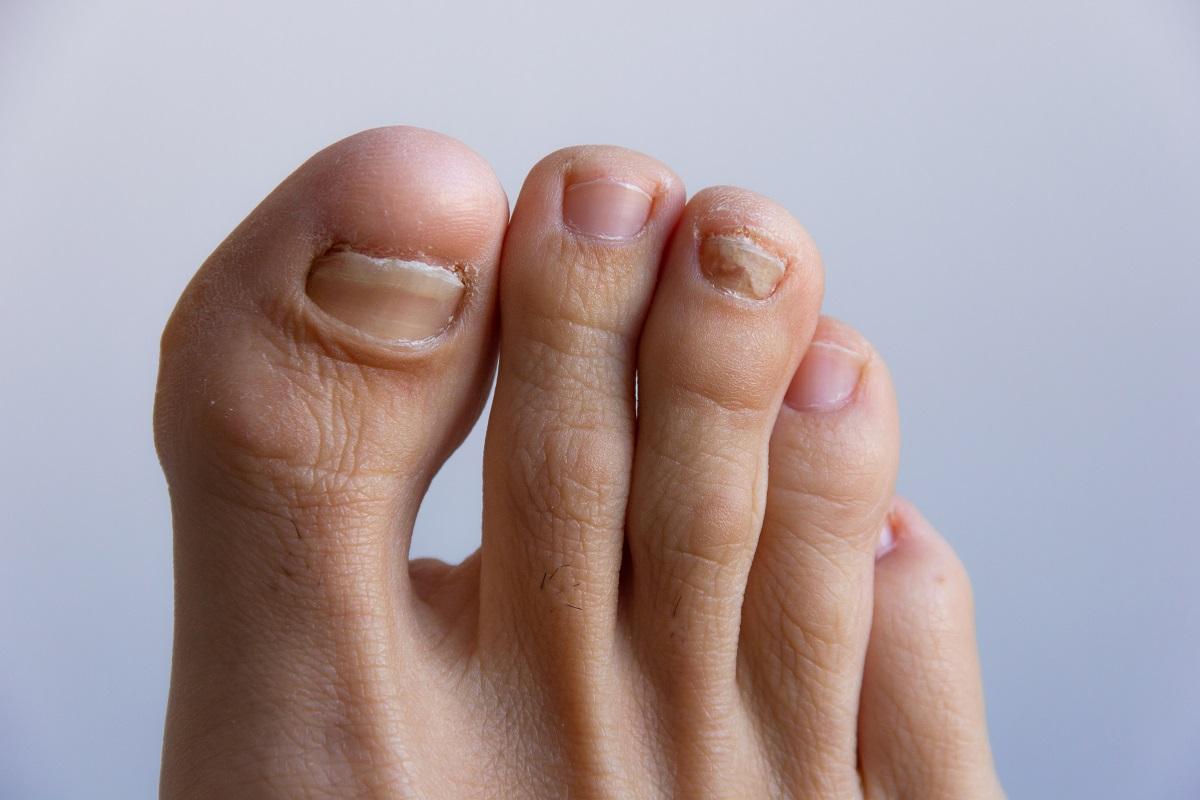 Cambios de color en las uñas o la aparición de rugosidades en ellas son algunas de las señales de problemas en los pies.