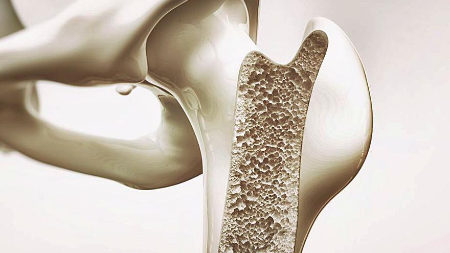 La osteoporosis debilita los huesos, facilitando roturas. | SHUTTERSTOCK