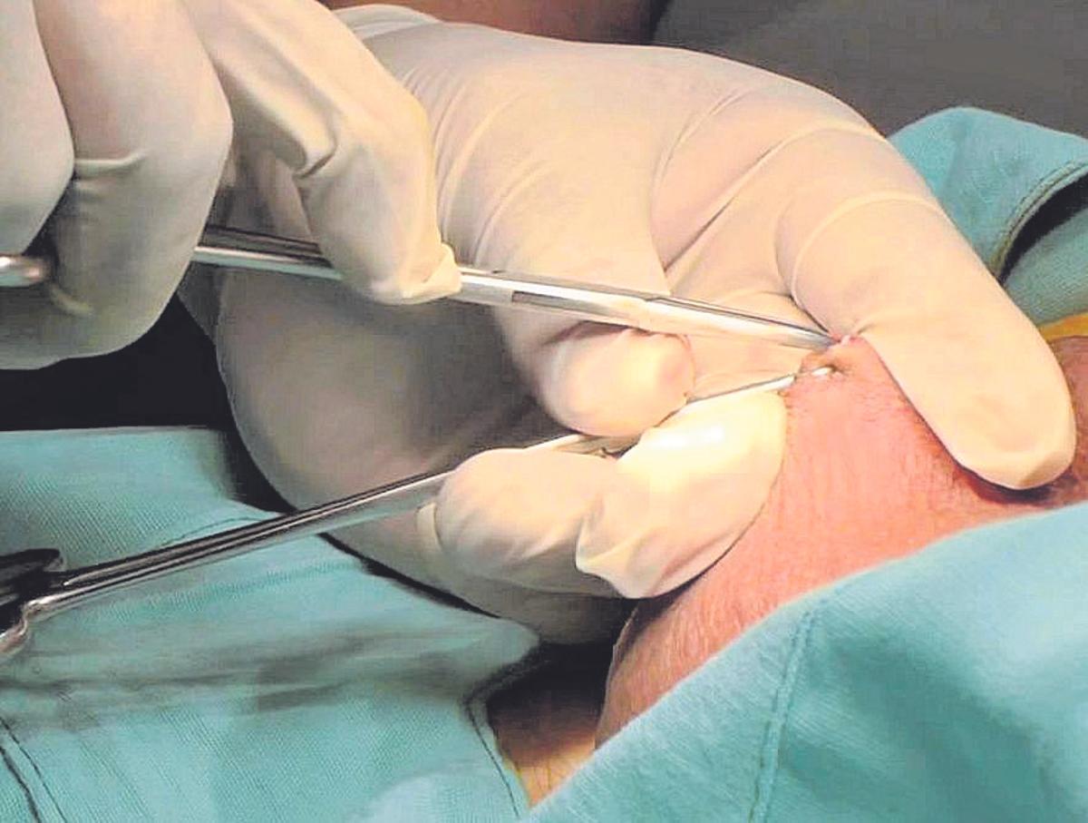 Vasectomía sin bisturí, rápida, eficaz y poco agresiva.