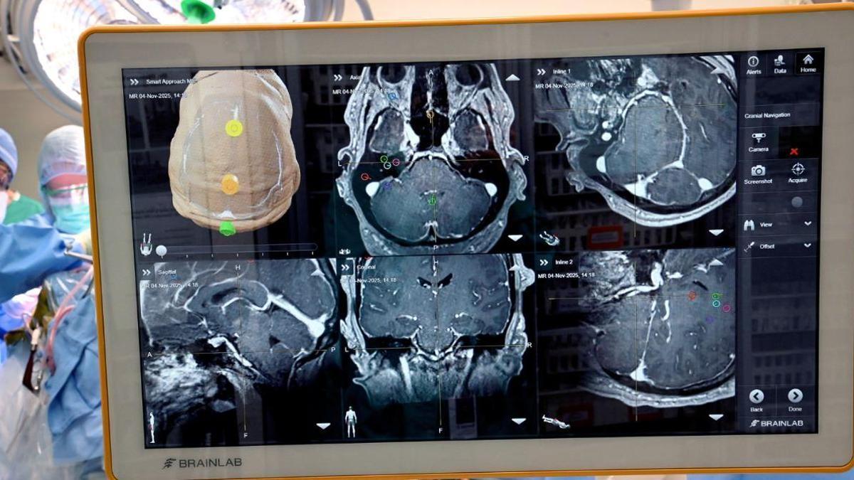 Implantan por primera vez una interfaz cerebro-ordenador en las capas superiores del cerebro