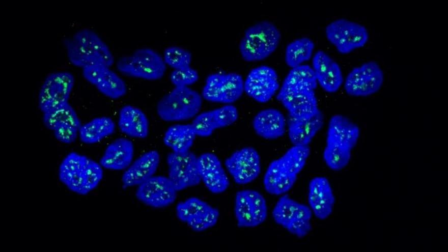 Una proteína mantiene en latencia las células metastáticas del cáncer de mama