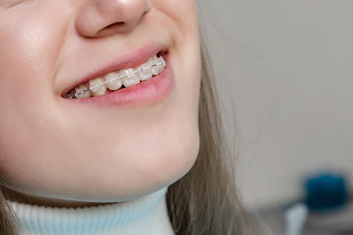 3 de cada 4 adolescentes llevan o han llevado ortodoncia.