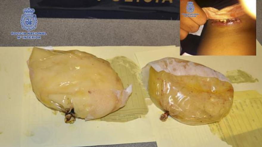 Implantes mamarios en cuyo interior se halló la droga. Arriba a la derecha, cicatriz de la detenida por la operación. | efe