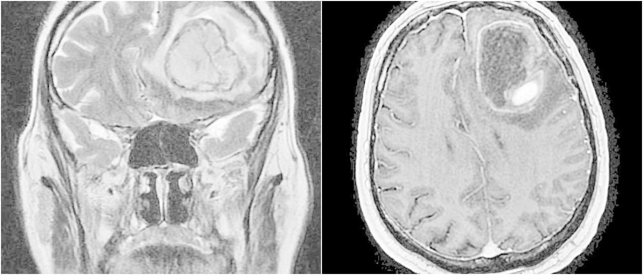 Imagen de una metástasis cerebral a nivel frontal izquierdo.